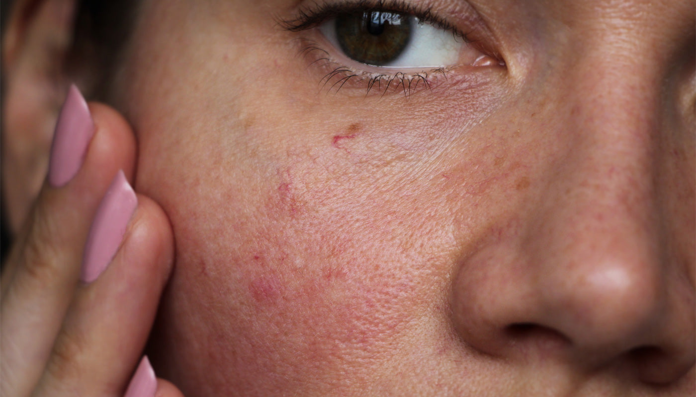 400 Million People in India Have Sensitive Skin: Understanding the Growing Epidemic